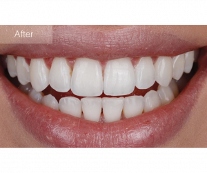יישור שיניים למבוגרים עם כתרים ושתלים האם זה אפשרי?